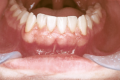Ha un tumore alla bocca da 5 anni ma i medici non se ne accorgono: «Ora non ho più i denti»