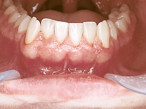 Ha un tumore alla bocca da 5 anni ma i medici non se ne accorgono: «Ora non ho più i denti»